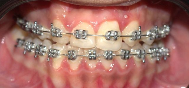 Management of dental anomalies in cleft patient after