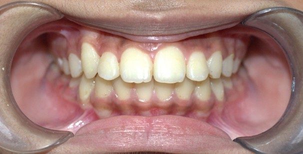 Management of extra tooth (supernumerary tooth) after