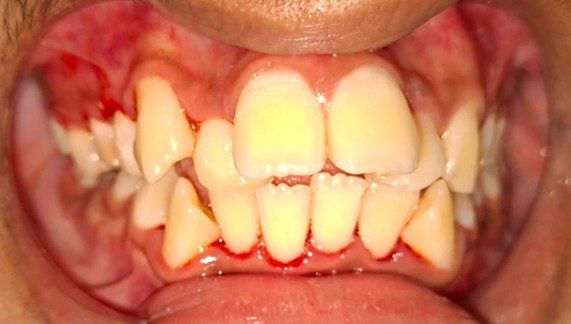 Management of gum diseases (gingivitis) after