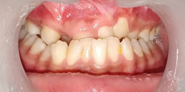 Management of dental anomalies in cleft patient before