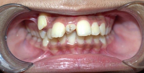 Management of extra tooth (supernumerary tooth) before