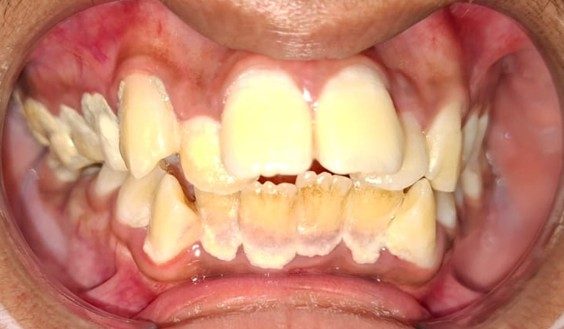 Management of gum diseases (gingivitis) before