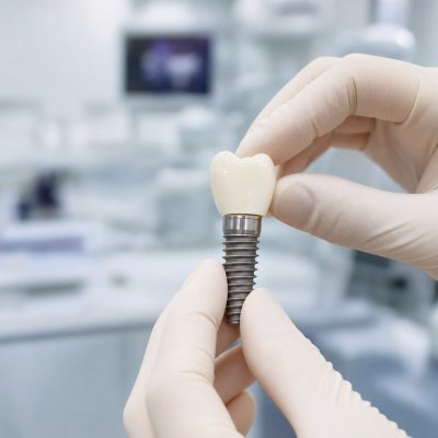 Dental Implants